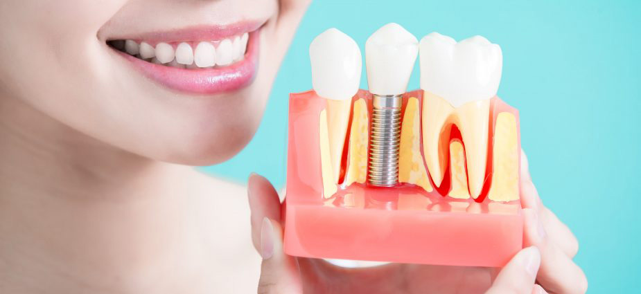 Implants fit like Your original teeth